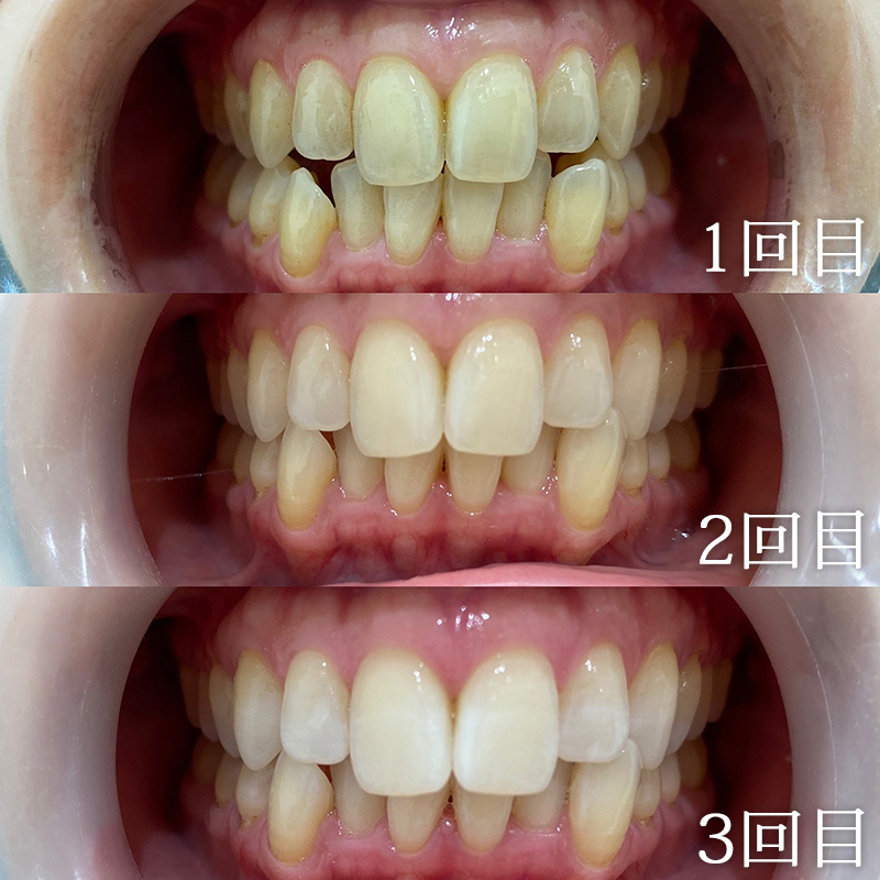 富士市ホワイトニングのビューティフルホワイトニングの３回施術後の歯の画像